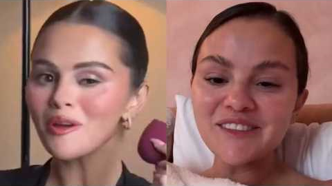 Selena Gomez ADDICTION To Fillers Is DESTROYING Her Face